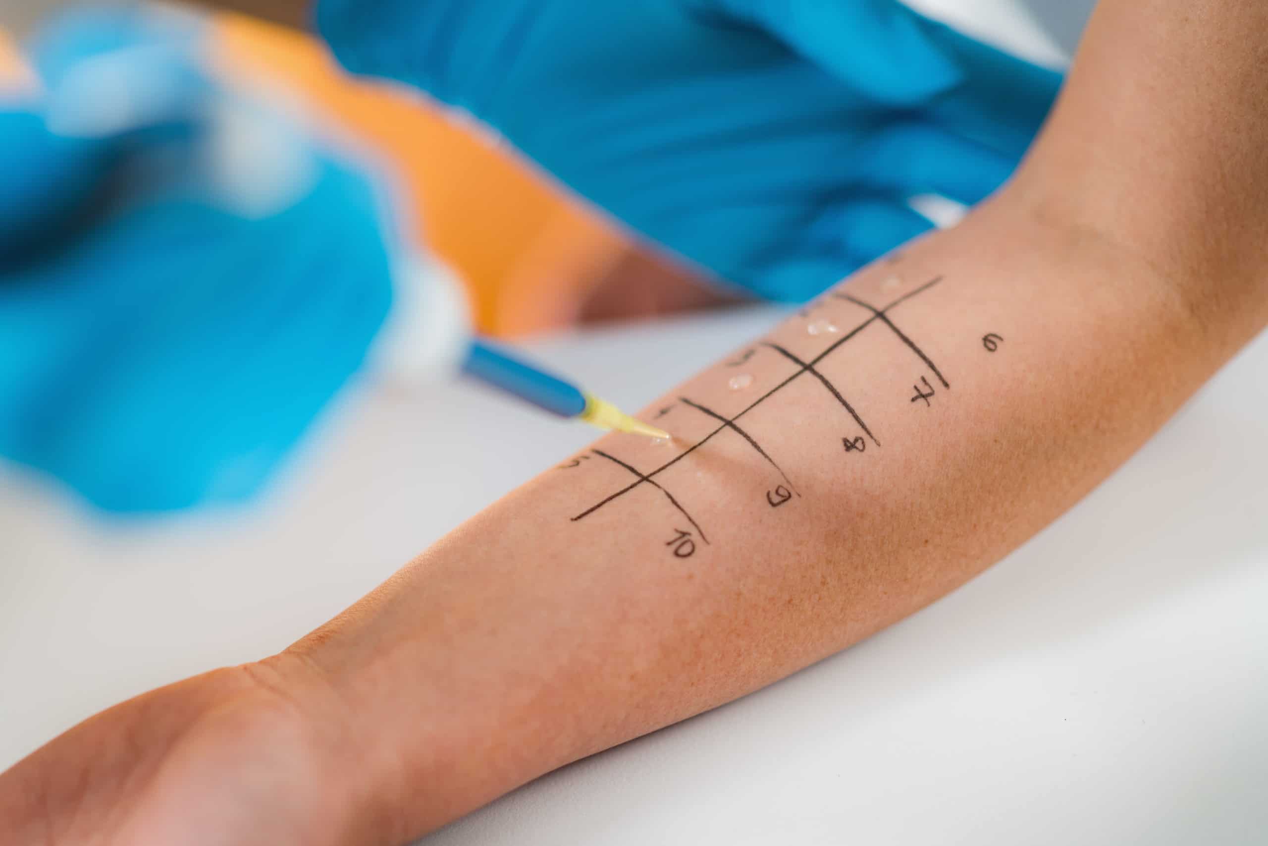 allergy-testing-dlzepvf-scaled